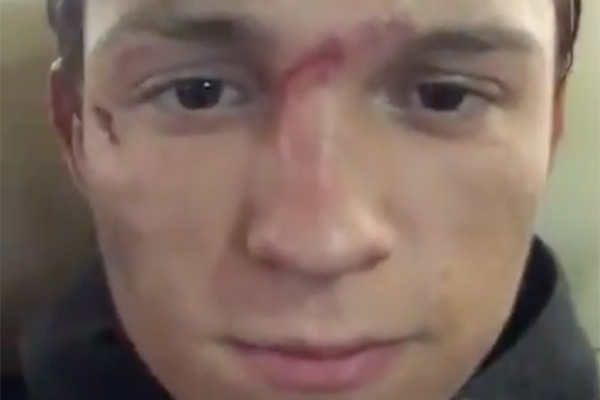 Tom Holland se rompe la nariz